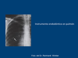 Instrumento endodóntico en pulmón
Foto: del Dr. Reinhardt Winkler
 