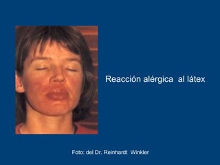 Foto: del Dr. Reinhardt Winkler
Reacción alérgica al látex
 