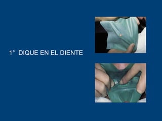 1° DIQUE EN EL DIENTE
 