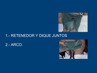 1.- RETENEDOR Y DIQUE JUNTOS
2.- ARCO.
 