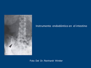 Instrumento endodóntico en pulmón
Foto: del Dr. Reinhardt Winkler
 