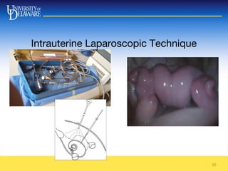 35
Intrauterine Laparoscopic Technique
 