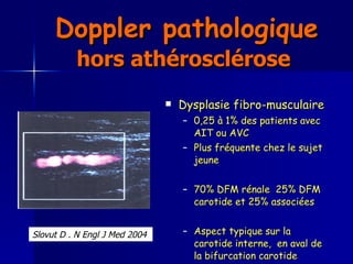 Doppler pathologique  hors athérosclérose   Dysplasie fibro-musculaire  0,25 à 1% des patients avec AIT ou AVC  Plus fréquente chez le sujet jeune  70% DFM rénale  25% DFM carotide et 25% associées Aspect typique sur la carotide interne,  en aval de la bifurcation carotide Slovut D . N Engl J Med 2004   