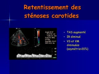 Retentissement des sténoses carotides   TAS augmenté IR diminué VS et VM diminuées (asymétrie>20%) 