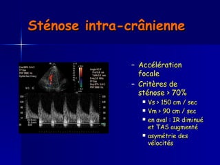 Sténose intra-crânienne   Accélération focale  Critères de sténose > 70% Vs > 150 cm / sec Vm > 90 cm / sec  en aval : IR diminué et TAS augmenté asymétrie des vélocités 