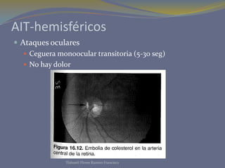 AIT-hemisféricos
 Ataques oculares
    Ceguera monoocular transitoria (5-30 seg)
    No hay dolor




               Tlahuetl Flores Ramiro Francisco
 