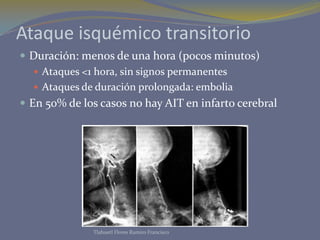 Ataque isquémico transitorio
 Duración: menos de una hora (pocos minutos)
 Ataques <1 hora, sin signos permanentes
 Ataques de duración prolongada: embolia
 En 50% de los casos no hay AIT en infarto cerebral
Tlahuetl Flores Ramiro Francisco
 