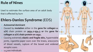 Rule of Nines
Used to estimate the surface area of an adult body
that is affected by burn
22
 Autosomal dominant
 Caused by mutation either in the gene for collagen a-
1(V) chain protein on 9q34.2-q34.3 or the gene for
collagen a-2(V) chain protein on 2q31.
 Causing extremely elastic and fragile skin, hypermobile
joints, cigarette-paper scars over the knees, aneurysms
of blood vessels, rupture of the bowel and widened
atrophic scars.
 1:5,000 individuals
Ehlers-Danlos Syndrome (EDS)
 