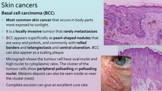 Skin cancers
Basal cell carcinoma (BCC)
 Most common skin cancer that occurs in body parts
most exposed to sunlight.
 It is a locally invasive tumour that rarely metastasizes
 BCC appears superficially as pearl-shaped nodules that
are waxy and pinkish, and commonly with rolled
borders and telangiectasis and central ulceration. BCC
can also appear as a scaling plaque
 Micrograph shows the tumour cell have oval nuclei and
high nuclei to cytoplasmic ratio.The cluster of the
tumour cells show peripheral palisading or palisading
nuclei. Melanin deposit can also be seen inside or near
the cluster (nest)
 Complete excision can give an excellent cure rate
23
 