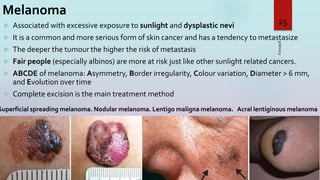 Melanoma
 Associated with excessive exposure to sunlight and dysplastic nevi
 It is a common and more serious form of skin cancer and has a tendency to metastasize
 The deeper the tumour the higher the risk of metastasis
 Fair people (especially albinos) are more at risk just like other sunlight related cancers.
 ABCDE of melanoma: Asymmetry, Border irregularity, Colour variation, Diameter > 6 mm,
and Evolution over time
 Complete excision is the main treatment method
3/16/2023
25
Superficial spreading melanoma. Nodular melanoma. Lentigo maligna melanoma. Acral lentiginous melanoma
 