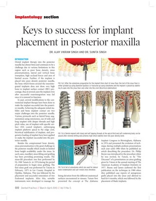 Dental Practice // March-April 2013 // Vol 11 No 500
Keys to success for implant
placement in posterior maxilla
implantology section
INTRODUCTION
Dental implant therapy into the posterior
maxilla has always been and continues to be a
challenge due to various limitations in this
region such as poor bone density, sinus
pneumatization, lateral and vertical bone
resorption, high occlusal forces and area of
limited access. Further, if the implant is
placed into poor density posterior maxilla,
the bone which forms around the osseointe-
grated implants does not show very high
bone to implant surface contact (BIC) per-
centage, thus in several cases the implant even
after successful osseointegration may fail
once it is restored in function.
In past, several modifications to the con-
ventional implant therapy have been done to
make the implant successful into the posteri-
or maxilla. Achieving the adequate initial sta-
bility and bone implant contact are two
major challenges into the posterior maxilla.
Various protocols such as lateral bone aug-
mentation using osteotomes, use of wide and
long implant with deeper threads and high
pitch value, use of implant with specific sur-
face (HA coated implant), submerging
implant platform apical to the ridge crest,
bicortical stabilization of implant, and pro-
gressive loading of implant have been applied
to make the implant successful into the pos-
terior maxilla.
Besides the compromised bone density,
sinus pneumatization is the great challenge in
the posterior maxilla which results in limited
bone height availability under the sinus. In
such cases, maxillary sinus lifting and grafting
has been providing promising results. The
sinus-lift procedure was first performed by
Dr. Hilt Tatum Jr. in 1974 during his period
of preparation to begin sinus grafting. The
first sinus graft was performed by Tatum in
February, 1975 in Lee County Hospital in
Opelika, Alabama. This was followed by the
placement and successful restoration of two
Endosteal implants. After this, suitable
instruments were developed to manage the
lining elevation from the different anatomical
surfaces encountered in sinuses. Tatum first
presented the concept at The Alabama
Implant Congress in Birmingham, Alabama
in 1976 and presented the evolution of tech-
nique during multiple podium presentations
each year until 1986 when he published an
article describing the procedure. Dr. Philip
Boyne was introduced to the procedure when
he was invited, by Tatum, to be "The
Discusser" of a presentation on sinus grafting
given by Tatum at the annual meeting of The
American Academy of Implant Dentistry in
1977. Boyne and James authored the first
publication on the technique in 1980 when
they published case reports of autogenous
grafts placed into the sinus and allowed to
heal for 6 months, which was followed by the
placement of blade implants.
FIG 3 & 6: Dental implant with sharp and self tapping threads at the apical third and self condensing body can be
placed after minimal drilling and achieves high initial stability even into poor density bone.
FIG 7 & 8: Set of osteotomes which are used for lateral
bone condensation and sub-crestal sinus elevation.
FIG 1 & 2: After the osteotomy preparation for the implant 2mm short of sinus floor, the rest of the sinus floor is
either grinded up using diamond tips/burs or fractured up using osteotome and the implant is placed by stabilis-
ing its apex into the sinus floor and collar into the crest (Bicortical stabilization)
DR. AJAY VIKRAM SINGH AND DR. SUNITA SINGH
 