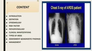 Comprehensive Overview of Acute Respiratory Distress Syndrome (ARDS ...