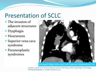 Presentation of SCLC
 90%–95% occur
centrally
 Arising in a lobar or
main bronchus
 Symptoms:
 Dyspnea
 Persistent cough
 Hemoptysis
 Postobstructive
pneumonia
Chong S, Lee KS, et al. Neuro endocrine tumors of the lung: clinical, pathologic and imaging
findings.Radiographics. 2006Jan-Feb26(1):41-57.
Bilateral enlargement at pulmonary hilumEnlarged Right hilar and Left Superior Mediastinal LN
 The invasion of
adjacent structures
 Dysphagia
 Hoarseness
 Superior vena cava
syndrome
 Paraneoplastic
syndromes
 