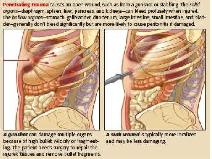 Image result for Stomach and Small Bowel Injuries