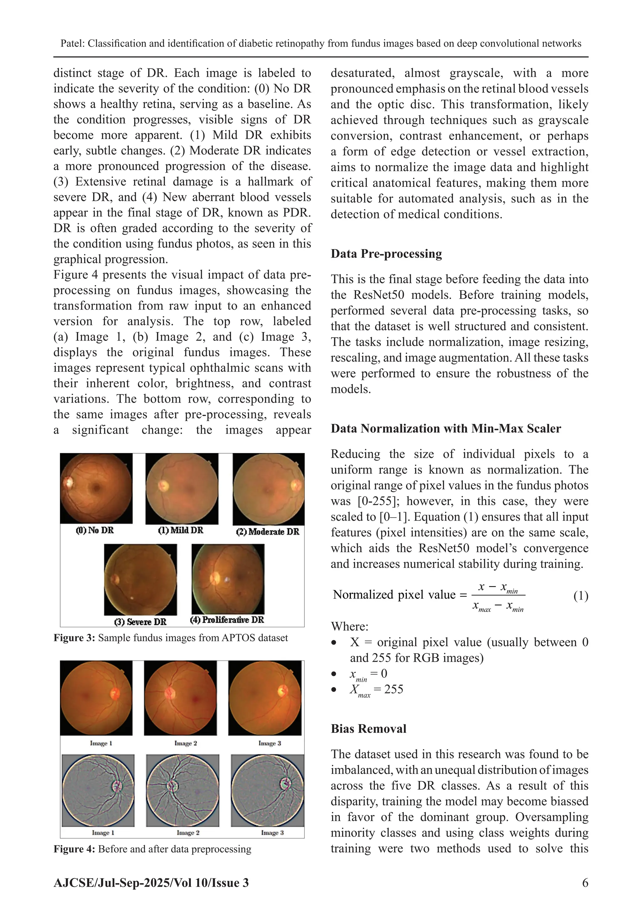 Patel: Classification and identification of diabetic retinopathy from fundus images based on deep convolutional networks
AJCSE/Jul-Sep-2025/Vol 10/Issue 3 6
distinct stage of DR. Each image is labeled to
indicate the severity of the condition: (0) No DR
shows a healthy retina, serving as a baseline. As
the condition progresses, visible signs of DR
become more apparent. (1) Mild DR exhibits
early, subtle changes. (2) Moderate DR indicates
a more pronounced progression of the disease.
(3) Extensive retinal damage is a hallmark of
severe DR, and (4) New aberrant blood vessels
appear in the final stage of DR, known as PDR.
DR is often graded according to the severity of
the condition using fundus photos, as seen in this
graphical progression.
Figure 4 presents the visual impact of data pre-
processing on fundus images, showcasing the
transformation from raw input to an enhanced
version for analysis. The top row, labeled
(a) Image 1, (b) Image 2, and (c) Image 3,
displays the original fundus images. These
images represent typical ophthalmic scans with
their inherent color, brightness, and contrast
variations. The bottom row, corresponding to
the same images after pre-processing, reveals
a significant change: the images appear
desaturated, almost grayscale, with a more
pronounced emphasis on the retinal blood vessels
and the optic disc. This transformation, likely
achieved through techniques such as grayscale
conversion, contrast enhancement, or perhaps
a form of edge detection or vessel extraction,
aims to normalize the image data and highlight
critical anatomical features, making them more
suitable for automated analysis, such as in the
detection of medical conditions.
Data Pre-processing
This is the final stage before feeding the data into
the ResNet50 models. Before training models,
performed several data pre-processing tasks, so
that the dataset is well structured and consistent.
The tasks include normalization, image resizing,
rescaling, and image augmentation.All these tasks
were performed to ensure the robustness of the
models.
Data Normalization with Min-Max Scaler
Reducing the size of individual pixels to a
uniform range is known as normalization. The
original range of pixel values in the fundus photos
was [0-255]; however, in this case, they were
scaled to [0–1]. Equation (1) ensures that all input
features (pixel intensities) are on the same scale,
which aids the ResNet50 model’s convergence
and increases numerical stability during training.
Normalized pixel value =
−
−
x x
x x
min
max min
(1)
Where:
• X = original pixel value (usually between 0
and 255 for RGB images)
• xmin
= 0
• Xmax
= 255
Bias Removal
The dataset used in this research was found to be
imbalanced, with an unequal distribution of images
across the five DR classes. As a result of this
disparity, training the model may become biassed
in favor of the dominant group. Oversampling
minority classes and using class weights during
training were two methods used to solve this
Figure 3: Sample fundus images from APTOS dataset
Figure 4: Before and after data preprocessing
 