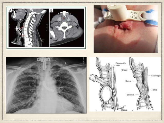 Tracheostomy (postop care & complications) | PPTX
