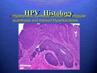 
           HPV Histology
    Hyperplastic Epithelial Growth with irregular
    acanthosis and marked Hyperkeratosis
 