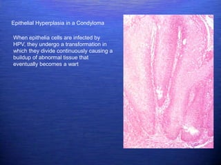 Epithelial Hyperplasia in a Condyloma

When epithelia cells are infected by
HPV, they undergo a transformation in
which they divide continuously causing a
buildup of abnormal tissue that
eventually becomes a wart
 