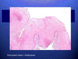 Perinuclear Halos = Koilocytosis
 