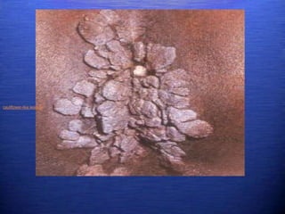 cauliflower-like lesions
 