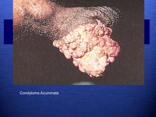 Condyloma Acuminata
 