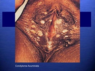 Condyloma Acuminata
 