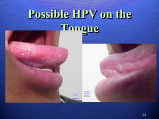 Possible HPV on the
      Tongue




                      33
 