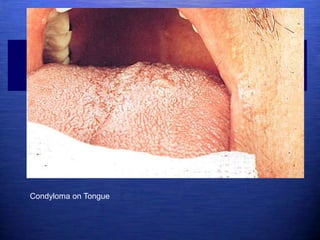 Condyloma on Tongue
 