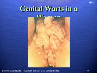HPV


                 Genital Warts in a
                      Woman




Source: CDC/NCHSTP/Division of STD, STD Clinical Slides   36
 