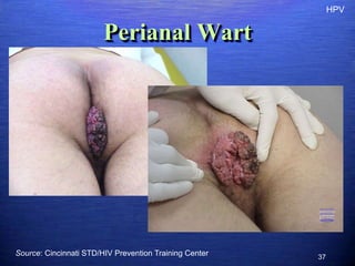 HPV


                        Perianal Wart




Source: Cincinnati STD/HIV Prevention Training Center   37
 