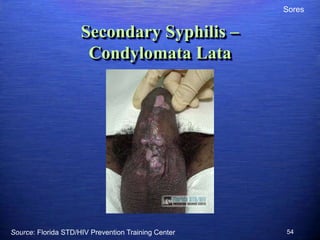 Sores


                     Secondary Syphilis –
                      Condylomata Lata




Source: Florida STD/HIV Prevention Training Center   54
 