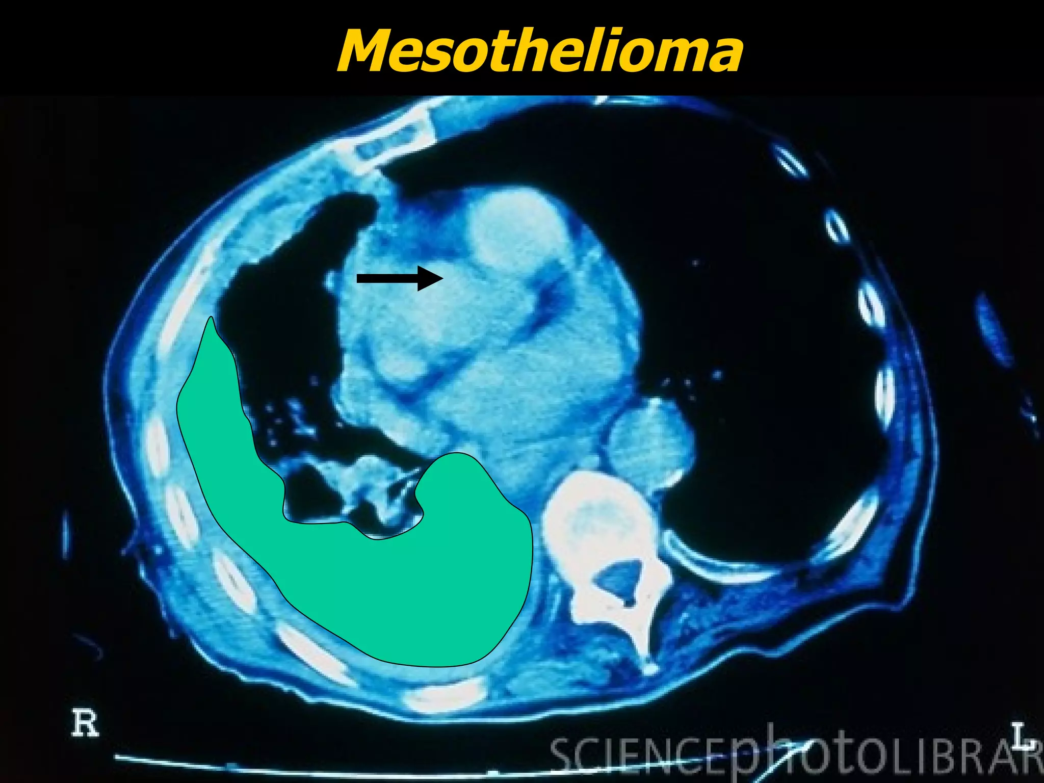 Mesothelioma




Copyright © 2007, TWI Ltd   24   World Centre for Materials Joining Technology
 