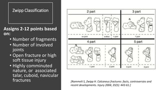 Zwipp Classification
Assigns 2-12 points based
on:
• Number of fragments
• Number of involved
joints
• Open fracture or high
soft tissue injury
• Highly comminuted
nature, or associated
talar, cuboid, navicular
fractures [Rammelt S, Zwipp H. Calcaneus fractures: facts, controversies and
recent developments. Injury 2004; 35(5): 443-61.]
 
