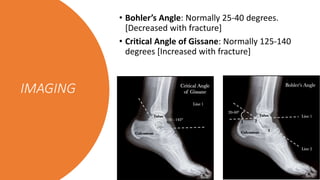 IMAGING
• Bohler’s Angle: Normally 25-40 degrees.
[Decreased with fracture]
• Critical Angle of Gissane: Normally 125-140
degrees [Increased with fracture]
 