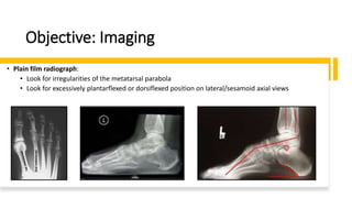 Objective: Imaging
• Plain film radiograph:
• Look for irregularities of the metatarsal parabola
• Look for excessively plantarflexed or dorsiflexed position on lateral/sesamoid axial views
 