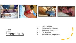 Five
Emergencies
1. Open Fractures
2. Compartment Syndrome
3. Necrotizing Fasciitis
4. Gas Gangrene
5. Neurovascular compromise
 