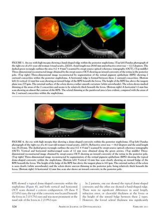 Dome Shaped Macula Pdf
