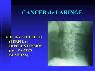 Telerex Protection CANCER de LARINGE2.pdfaaaaaaaaaaaaaaaaaa | PDF
