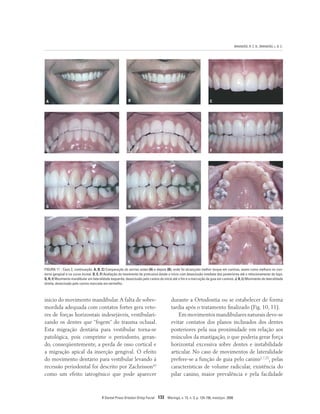 BRANDÃO, R. C. B.; BRANDÃO, L. B. C.
R Dental Press Ortodon Ortop Facial 133 Maringá, v. 13, n. 3, p. 124-156, maio/jun. 2008
FIGURA 11 - Caso 2, continuação. A, B, C) Comparação do sorriso antes (A) e depois (B), onde foi alcançado melhor torque em caninos, assim como melhora no con-
torno gengival e na curva incisal. D, E, F) Avaliação do movimento de protrusiva desde o início com desoclusão imediata dos posteriores até o relacionamento de topo.
G, H, I) Movimento mandibular em lateralidade esquerda, desoclusão pelo canino do início até o fim e a marcação da guia em caninos. J, K, L) Movimento de lateralidade
direita, desoclusão pelo canino marcada em vermelho.
B
A C
E
D F
H
G I
K
J L
início do movimento mandibular.A falta de sobre-
mordida adequada com contatos fortes gera veto-
res de forças horizontais indesejáveis, vestibulari-
zando os dentes que “fogem” do trauma oclusal.
Esta migração dentária para vestibular torna-se
patológica, pois comprime o periodonto, geran-
do, conseqüentemente, a perda de osso cortical e
a migração apical da inserção gengival. O efeito
do movimento dentário para vestibular levando à
recessão periodontal foi descrito por Zachrisson42
como um efeito iatrogênico que pode aparecer
durante a Ortodontia ou se estabelecer de forma
tardia após o tratamento finalizado (Fig. 10, 11).
Em movimentos mandibulares naturais deve-se
evitar contatos dos planos inclinados dos dentes
posteriores pela sua proximidade em relação aos
músculos da mastigação, o que poderia gerar força
horizontal excessiva sobre dentes e instabilidade
articular. No caso de movimentos de lateralidade
prefere-se a função de guia pelo canino1,7,23
, pelas
características de volume radicular, existência do
pilar canino, maior prevalência e pela facilidade
 