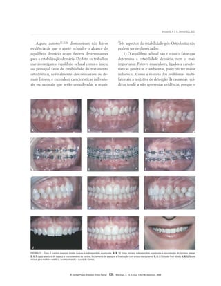 BRANDÃO, R. C. B.; BRANDÃO, L. B. C.
R Dental Press Ortodon Ortop Facial 135 Maringá, v. 13, n. 3, p. 124-156, maio/jun. 2008
Alguns autores12,15,16
demonstram não haver
evidência de que o ajuste oclusal e o alcance do
equilíbrio dentário sejam fatores determinantes
para a estabilização dentária. De fato, os trabalhos
que investigam o equilíbrio oclusal como o único,
ou principal fator de estabilidade do tratamento
ortodôntico, normalmente desconsideram os de-
mais fatores, e escondem características individu-
ais ou sazonais que serão consideradas a seguir.
Três aspectos da estabilidade pós-Ortodontia não
podem ser negligenciados:
1) O equilíbrio oclusal não é o único fator que
determina a estabilidade dentária, nem o mais
importante. Fatores musculares, ligados a caracte-
rísticas genéticas e ambientas, parecem ter maior
influência. Como a maioria dos problemas multi-
fatoriais, a tentativa de detecção da causa das reci-
divas tende a não apresentar evidência, porque o
A
D
B
E
C
F
G H I
J K L
FIGURA 12 - Caso 3: canino superior direito incluso e sobremordida acentuada. A, B, C) Fotos iniciais, sobremordida acentuada e microdontia do incisivo lateral.
D, E, F) Após abertura de espaço e tracionamento do canino, fechamento de espaços e finalização com arcos retangulares. G, H, I) Oclusão final obtida. J, K, L) Ajuste
incisal para melhora estética, acompanhando a curva do sorriso.
 