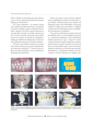 Ajuste oclusal na Ortodontia: por que, quando e como?
R Dental Press Ortodon Ortop Facial 136 Maringá, v. 13, n. 3, p. 124-156, maio/jun. 2008
A B C
D E F
G H I
EQUILÍBRIO
FIGURA 13 - Caso 3, continuação. A, B, C) Abertura de diastema por vestibularização de canino e incisivo lateral superior direito. D, E, F) Obtenção de registro de mordida
em RC com uso das “Tiras de Long”. G, H, I) Montagem em articulador, verificando desvio para anterior e para direita por contato de “Equilíbrio” no segundo molar do
lado esquerdo.
efeito é diluído ou mascarado por outros fatores,
como é visto na maioria dos desenhos de pesquisa
disponíveis na literatura3,29
.
2) O mais importante - os contatos oclusais
sem equilíbrio só podem gerar força e conseqüente
movimento dentário quando considerada intensi-
dade e duração. Uma força só gera movimento se
exercida sobre um dente, em média, seis horas por
dia31
. Se forem somadas as horas que nossos dentes
entram em contato, nas funções de mastigação e
deglutição, dificilmente ultrapassarão 3 horas diá-
rias, insuficientes para gerar movimento dentário.
3) Existe uma tendência natural ao aumento
dos contatos oclusais, nos seis meses subseqüentes
ao tratamento ortodôntico14,34
, havendo uma me-
lhora que pode compensar a menor qualidade na
finalização dos tratamentos.
Todos estes fatores acima descritos explicam
tanto a estabilidade encontrada na maioria dos ca-
sos tratados ortodonticamente sem requintes de
finalização, assim como a dificuldade e carência de
evidência científica, que possa definir o equilíbrio
oclusal como fator determinante para a estabilida-
de dos tratamentos ortodônticos.
O que não é considerado nos estudos,e faz parte
da realidade clínica, é a eventualidade do paciente
vir a apresentar parafunções, como apertamento
dentário, fazendo com que o tempo de contato
oclusal aumente de maneira significativa, transfor-
mando forças de contato constantes em vetores de
força cujo desequilíbrio passa a gerar movimentos
dentários indesejáveis, já descritos anteriormente.
Normalmente, o apertamento dentário está rela-
cionado ao estresse, depressão ou angústia, mui-
 