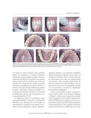 BRANDÃO, R. C. B.; BRANDÃO, L. B. C.
R Dental Press Ortodon Ortop Facial 137 Maringá, v. 13, n. 3, p. 124-156, maio/jun. 2008
E F
A B C D
G H I
FIGURA 14 - Caso 3, continuação. A) Manipulação guiada do paciente para encontrar contato em RC. B, C, D) Verificação do desvio de RC para MIH de 1mm, mas que
gerava vibração dos dentes superiores pela força horizontal resultante (Frêmito). E, F) Comparação dos contatos anteriores em RC (E) e MIH (F), que geram migração
dentária para vestibular. G, H, I) Ajuste oclusal por desgaste, em RC, cujo limite é o contato suave dos dentes anteriores.
to comum na nossa sociedade. Estes episódios
podem ser esporádicos, ou mesmo freqüentes,
e podem pré-existir ou aparecer posteriormente ao
tratamento ortodôntico. O exemplo desta seqüela
pode ser visto onde há prevalência do contato de
equilíbrio em detrimento do contato de parada,
desviando a mandíbula para anterior durante a
oclusão. A força horizontal, resultante do contato
excessivo entre dentes anteriores em MIH, cau-
sa abertura de diastemas anteriores e movimento
vestibular destes dentes, com conseqüente reces-
são periodontal (Fig. 12-15).
O diagnóstico prévio de parafunções, como
apertamento dentário e bruxismo, é mais fácil em
indivíduos que apresentem-as com freqüência,
especialmente se avaliados na fase aguda. Encon-
tram-se facetas desgastadas, cúspides aplainadas,
migrações dentárias com diastemas, mobilidade
dentária, limitação da abertura bucal, estalos ou
crepitações articulares, dores e edemas muscula-
res. Normalmente não todas, mas algumas destas
características estão presentes, dependendo do
limiar de tolerância de cada indivíduo, já que al-
gumas partes do sistema estomatognático podem
ser mais resistentes ou suscetíveis à hiperfunção
da musculatura mastigatória.
Como já incorporado ao nosso conhecimen-
to por estudo clássico de McNamara, Selligman
e Okesson21
, sabemos que o papel da má oclusão
como determinante de desordem temporoman-
dibular (DTM) só tem correlação com cinco ca-
racterísticas oclusais: mordida aberta esquelética,
overjet maior que 6 a 7mm, mordida cruzada uni-
lateral, desvios de RC para MIH maior que 4mm,
 