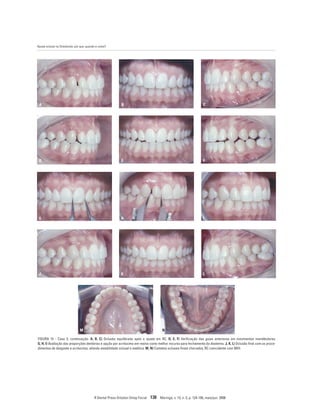 Ajuste oclusal na Ortodontia: por que, quando e como?
R Dental Press Ortodon Ortop Facial 138 Maringá, v. 13, n. 3, p. 124-156, maio/jun. 2008
FIGURA 15 - Caso 3, continuação. A, B, C) Oclusão equilibrada após o ajuste em RC. D, E, F) Verificação das guias anteriores em movimentos mandibulares.
G, H, I) Avaliação das proporções dentárias e opção por acréscimo em resina como melhor recurso para fechamento do diastema. J, K, L) Oclusão final com os proce-
dimentos de desgaste e acréscimo, aliando estabilidade oclusal e estética. M, N) Contatos oclusais finais checados, RC coincidente com MIH.
G
J
M
H
K
N
I
L
A B C
D E F
 