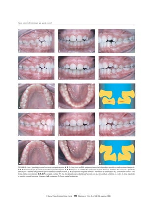 Ajuste oclusal na Ortodontia: por que, quando e como?
R Dental Press Ortodon Ortop Facial 140 Maringá, v. 13, n. 3, p. 124-156, maio/jun. 2008
FIGURA 16 - Caso 4: mordida cruzada funcional de origem dentária. A, B, C) Caso inicial em MIH apresenta desvio da linha média e mordida cruzada unilateral esquerda.
D, E, F) Manipulação em RC revela coincidência de linhas médias. G, H, I) Presença de contato “B” apenas de um lado dos arcos dentários, faz com que a mandíbula
desvie para o mesmo lado, podendo gerar mordida cruzada funcional . J, K, L) Depois do desgaste seletivo a mandíbula se estabiliza em RC, centralizada na face, com
linhas médias coincidentes. M, N, O) Presença de contato “B” dos dois lados dos arcos dentários, fazendo com que a mandíbula estabilize no centro da face, impedindo
a mordida cruzada funcional. (Imagens I e O cedidas por Dr. Paulo Isaias Seraidarian).
J K L
M N O
G H I
A B C
D E F
 