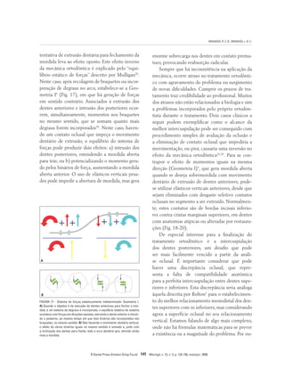 BRANDÃO, R. C. B.; BRANDÃO, L. B. C.
R Dental Press Ortodon Ortop Facial 141 Maringá, v. 13, n. 3, p. 124-156, maio/jun. 2008
FIGURA 17 - Sistema de forças estatiscamente indeterminado: Geometria I.
A) Quando o objetivo é de extrusão de dentes anteriores para fechar a mor-
dida, e um sistema de degraus é incorporado, o equilíbrio estático do sistema
acontece com forças em direções opostas, extruindo o dente anterior e intruin-
do o posterior, ao mesmo tempo em que dois binários são incorporados nos
braquetes, no mesmo sentido. B) Não havendo o movimento dentário vertical,
o efeito de vários binários iguais no mesmo sentido é somado e, junto com
a inclinação dos dentes para frente, todo o arco dentário gira, abrindo ainda
mais a mordida.
tentativa de extrusão dentária para fechamento da
mordida leva ao efeito oposto. Este efeito inverso
da mecânica ortodôntica é explicado pelo “equi-
líbrio estático de forças” descrito por Mulligan26
.
Neste caso, após recolagem de braquetes ou incor-
poração de degraus no arco, estabelece-se a Geo-
metria I5
(Fig. 17), em que há geração de forças
em sentido contrário. Associados à extrusão dos
dentes anteriores e intrusão dos posteriores ocor-
rem, simultaneamente, momentos nos braquetes
no mesmo sentido, que se somam quanto mais
degraus forem incorporados39
. Neste caso, haven-
do um contato oclusal que impeça o movimento
dentário de extrusão, o equilíbrio do sistema de
forças pode produzir dois efeitos: a) intrusão dos
dentes posteriores, estendendo a mordida aberta
para trás; ou b) potencializando o momento gera-
do pelos binários de força, aumentando a mordida
aberta anterior. O uso de elásticos verticais pesa-
dos pode impedir a abertura de mordida, mas gera
enorme sobrecarga nos dentes em contato prema-
turo, provocando reabsorção radicular.
Sempre que há inconsistência na aplicação da
mecânica, ocorre atraso no tratamento ortodônti-
co com agravamento do problema ou surgimento
de novas dificuldades. Cumprir os prazos de tra-
tamento traz credibilidade ao profissional. Muitos
dos atrasos não estão relacionados à biologia e sim
a problemas incorporados pelo próprio ortodon-
tista durante o tratamento. Dois casos clínicos a
seguir podem exemplificar como o alcance da
melhor intercuspidação pode ser conseguido com
procedimento simples de avaliação da oclusão e
a eliminação de contato oclusal que impediria a
movimentação, ou pior, causaria uma inversão no
efeito da mecânica ortodôntica26,39
. Para se con-
trapor o efeito de momentos iguais na mesma
direção (Geometria I)5
, que gera mordida aberta
quando se deseja sobremordida com movimento
dentário de extrusão de dentes anteriores, pode-
se utilizar elásticos verticais anteriores, desde que
sejam eliminados com desgaste seletivo contatos
oclusais no segmento a ser extruído. Normalmen-
te, estes contatos são de bordas incisais inferio-
res contra cristas marginais superiores, em dentes
com anatomias atípicas ou alteradas por restaura-
ções (Fig. 18-20).
De especial interesse para a finalização do
tratamento ortodôntico é a intercuspidação
dos dentes posteriores, um desafio que pode
ser mais facilmente vencido a partir da análi-
se oclusal. É importante considerar que pode
haver uma discrepância oclusal, que repre-
senta a falta de compatibilidade anatômica
para a perfeita intercuspidação entre dentes supe-
riores e inferiores. Esta discrepância seria análoga
àquela descrita por Bolton2
para o estabelecimen-
to do melhor relacionamento mesiodistal dos den-
tes superiores com os inferiores, mas considerando
agora a superfície oclusal no seu relacionamento
vertical. Estamos falando de algo mais complexo,
onde não há fórmulas matemáticas para se prever
a existência ou a magnitude do problema. Por ou-
A
B
 