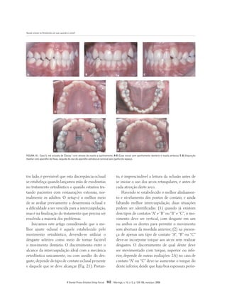 Ajuste oclusal na Ortodontia: por que, quando e como?
R Dental Press Ortodon Ortop Facial 142 Maringá, v. 13, n. 3, p. 124-156, maio/jun. 2008
A B C
D E
F G
to, é imprescindível a leitura da oclusão antes de
se iniciar o uso dos arcos retangulares, e antes de
cada ativação deste arco.
Havendo se estabelecido o melhor alinhamen-
to e nivelamento dos pontos de contato, e ainda
faltando melhor intercuspidação, duas situações
podem ser identificadas: (1) quando já existem
dois tipos de contatos “A” e “B” ou “B” e “C”, o mo-
vimento deve ser vertical, com desgaste em um
ou ambos os dentes para permitir o movimento
sem abertura da mordida anterior; (2) na presen-
ça de apenas um tipo de contato “A”, “B” ou “C”
deve-se incorporar torque aos arcos sem realizar
desgastes. O discernimento de qual dente deve
ser movimentado com torque, superior ou infe-
rior, depende de outras avaliações: 2A) no caso de
contato “A” ou “C” deve-se aumentar o torque do
dente inferior, desde que haja boa espessura perio-
tro lado, é previsível que esta discrepância oclusal
se estabeleça quando lançamos mão de exodontias
no tratamento ortodôntico e quando estamos tra-
tando pacientes com restaurações extensas, nor-
malmente os adultos. O setup é o melhor meio
de se avaliar previamente a desarmonia oclusal e
a dificuldade a ser vencida para a intercuspidação,
mas é na finalização do tratamento que precisa ser
resolvida a maioria dos problemas.
Iniciamos este artigo considerando que o me-
lhor ajuste oclusal é aquele estabelecido pelo
movimento ortodôntico, devendo-se utilizar o
desgaste seletivo como meio de tornar factível
o movimento dentário. O discernimento entre o
alcance da intercuspidação ideal com a mecânica
ortodôntica unicamente, ou com auxílio do des-
gaste, depende do tipo de contato oclusal presente
e daquele que se deve alcançar (Fig. 21). Portan-
FIGURA 18 - Caso 5: má oclusão de Classe I com atresia de maxila e apinhamento. A-E) Caso inicial com apinhamento dentário e maxila atrésica. F, G) Disjunção
maxilar com aparelho de Haas, seguida do uso de aparelho extrabucal cervical para ganho de espaço.
 
