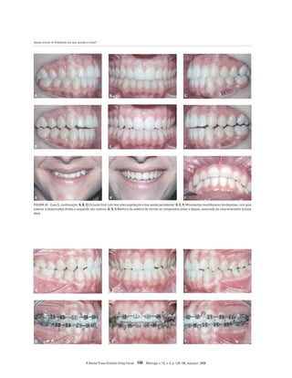 Ajuste oclusal na Ortodontia: por que, quando e como?
R Dental Press Ortodon Ortop Facial 144 Maringá, v. 13, n. 3, p. 124-156, maio/jun. 2008
A B C
D E F
FIGURA 20 - Caso 5, continuação. A, B, C) Oclusão final com boa intercuspidação e boa saúde periodontal. D, E, F) Movimentos mandibulares bordejantes, com guia
anterior e desoclusões direita e esquerda nos caninos. G, H, I) Melhora da estética do sorriso se comparados antes e depois, associado ao relacionamento oclusal
ideal.
A B C
D E F
G H I
 