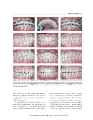 BRANDÃO, R. C. B.; BRANDÃO, L. B. C.
R Dental Press Ortodon Ortop Facial 145 Maringá, v. 13, n. 3, p. 124-156, maio/jun. 2008
G H I
além do risco de se gerar sensibilidade dentária,
demonstra limitação profissional, que deve ser
corrigida com a busca por maior conhecimento e
melhor treinamento.
O principal conceito a ser incorporado no trei-
namento do ortodontista é que não existe arco
ideal e nem prescrição ideal, dentre as inúmeras
técnicas disponíveis na Ortodontia. Todas as pres-
crições, inclusive o arco ideal da técnica Edgewi-
se11
, são estabelecidas para médias e algumas va-
riações de populações. A chance de um paciente
se encaixar perfeitamente em todas as caracterís-
ticas médias é semelhante à de se acertar na lote-
ria. Na finalização, o importante é a capacidade de
enxergar o problema, conhecer a solução, dominar
a técnica e o aparelho escolhido, intercuspidando
FIGURA 21 - Caso 6: má oclusão Classe III de Angle tratada por camuflagem. A, B, C) Caso inicial com mordida de topo anterior e desgastes incisais. D, E, F) Início da
finalização depois de uso intenso de elásticos intermaxilares, necessitando de aumento da sobremorida. G, H, I) Verificação da interferência pela crista marginal mesial
do canino superior ser volumosa, indicando desgaste seletivo para viabilizar o movimento dentário vertical. J, K, L) Caso final, com amplas compensações à desarmonia
esquelética e intercuspidação satisfatória. M, N, O) Vista dos encaixes das cúspides nos sulcos e fossas, e relacionamento incisal. P, Q, R) Movimentos mandibulares
em oclusão mutuamente protegida.
J K L
M N O
P Q R
 