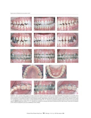 Ajuste oclusal na Ortodontia: por que, quando e como?
R Dental Press Ortodon Ortop Facial 146 Maringá, v. 13, n. 3, p. 124-156, maio/jun. 2008
A B C
D E F
G H I
L M N
J K
FIGURA 22 - Caso 7: paciente adulto, tratado com ampla compensação dentária e diferentes ações na finalização. A, B, C) Má oclusão Classe III com mordida aberta
anterior e postura baixa da língua. D, E, F) Depois de expansão do arco superior, iniciando o uso de esporões soldados em arco lingual. G, H, I ) Fase de finalização, com
arcos retangulares e necessidade de melhora na intercuspidação posterior. J, K) Problemas diferentes detectados na análise oclusal: do lado esquerdo só há contato
“C”, o que demanda acentuar o torque inferior, e no lado esquerdo há contatos “B” e “C”, indicando necessidade de desgaste e dobra em degrau no arco para extrusão
superior. L, M, N) Desgaste dos contatos “B” e “C”, realizados nas cúspides de contenção, pois estavam afastadas da ponta. Após alcançar a ponta deve-se desgastar
o sulco central do antagonista, para que se estabeleçam novos contatos.
 