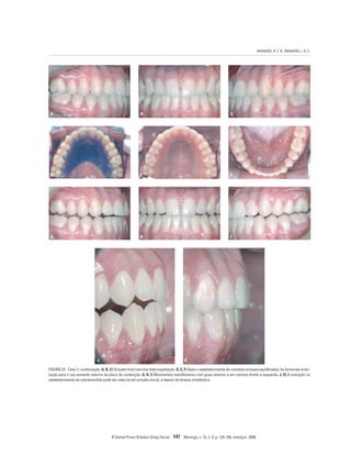 BRANDÃO, R. C. B.; BRANDÃO, L. B. C.
R Dental Press Ortodon Ortop Facial 147 Maringá, v. 13, n. 3, p. 124-156, maio/jun. 2008
FIGURA 23 - Caso 7, continuação. A, B, C) Oclusão final com boa intercuspidação. D, E, F) Após o estabelecimento de contatos oclusais equilibrados, foi fornecida orien-
tação para o uso somente noturno da placa de contenção. G, H, I) Movimentos mandibulares com guias anterior e em caninos direito e esquerdo. J, K) A evolução no
estabelecimento da sobremordida pode ser vista na má oclusão inicial, e depois da terapia ortodôntica.
A B C
D E F
G H I
J K
 